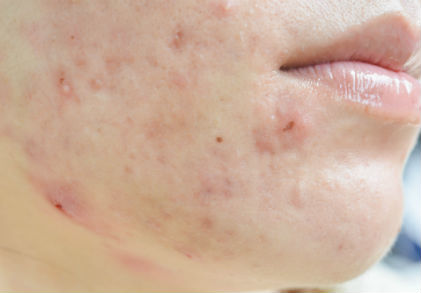 acne scar cream